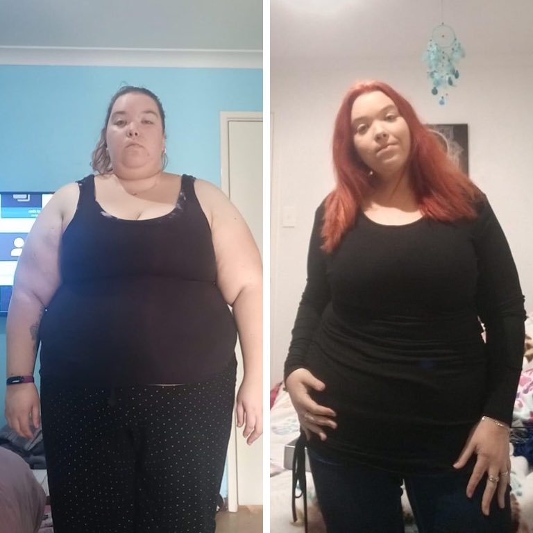 Bariatric Surgery Results From Real People In Perth